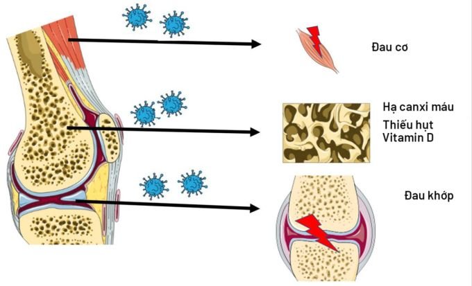 Joint pain can last a year after recovering from Covid